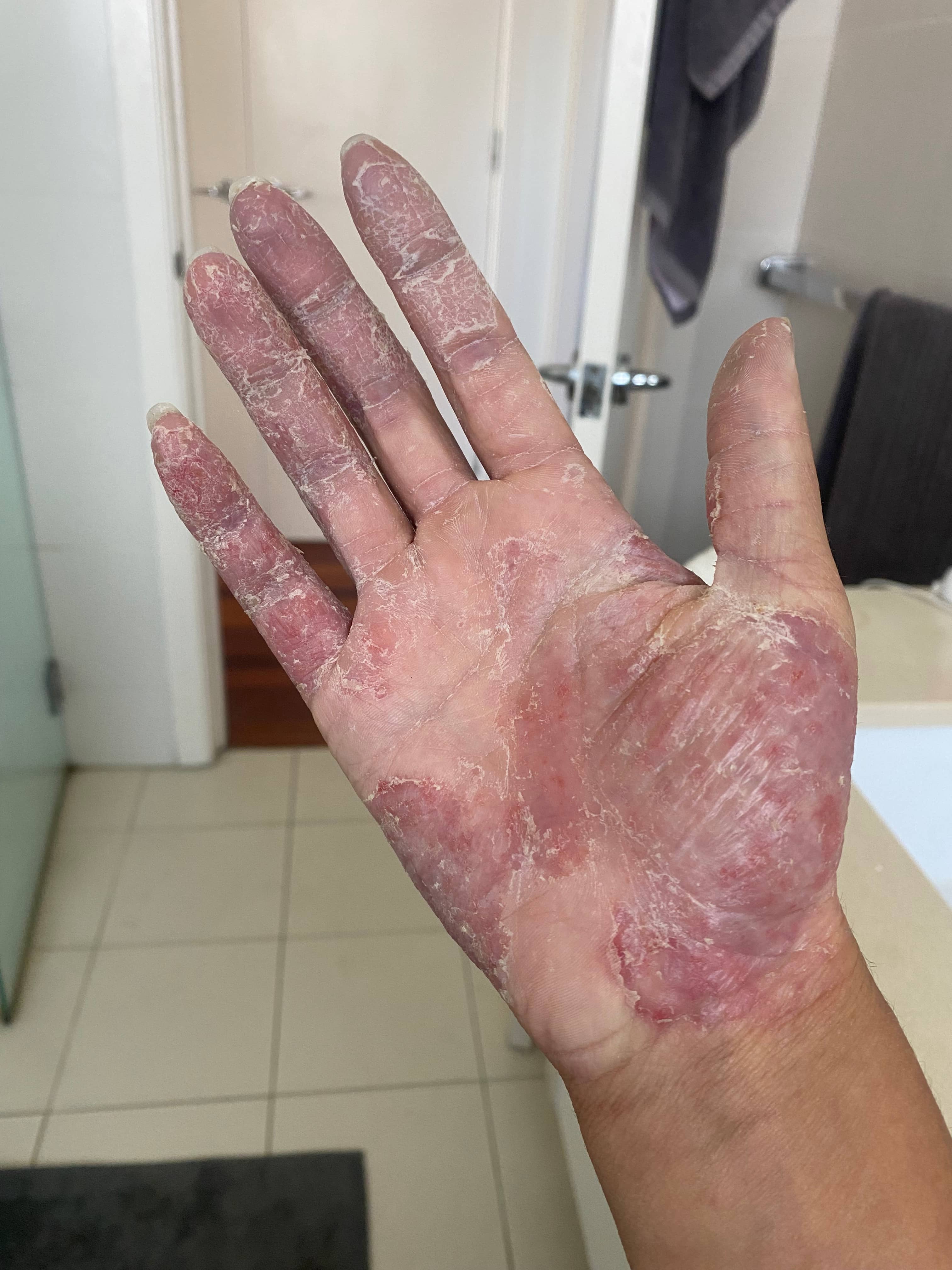 During eczema